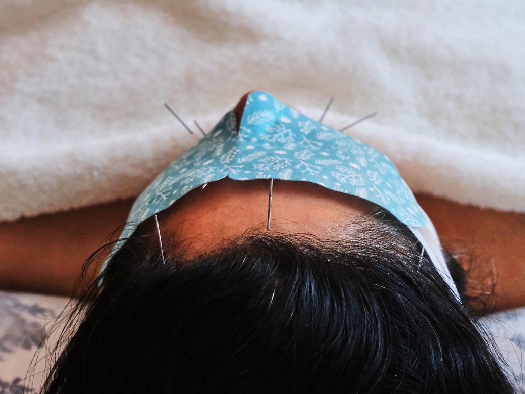 Fine acupuncture needles placed along the forehead and scalp of a resting patient